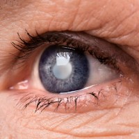 Cataracts