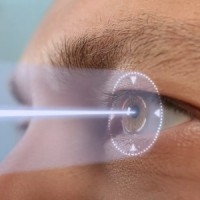 Refractive surgery
